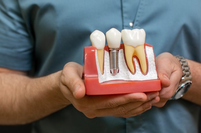 10-Things-You-Must-Know-Before-Getting-Dental-Implants