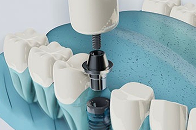 7-Reasons-why-3D-Guided-Dental-Implants-are-Beneficial