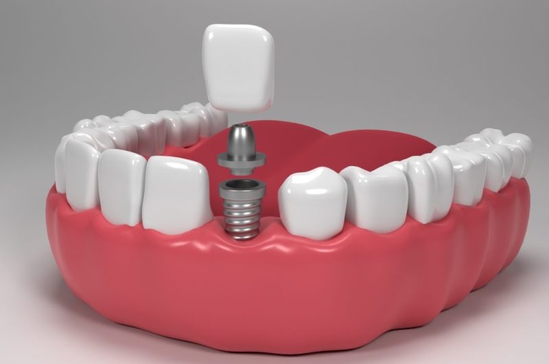 Front-Tooth-Implants-Ensuring-Natural-Appearance-and-Optimal-Functionality