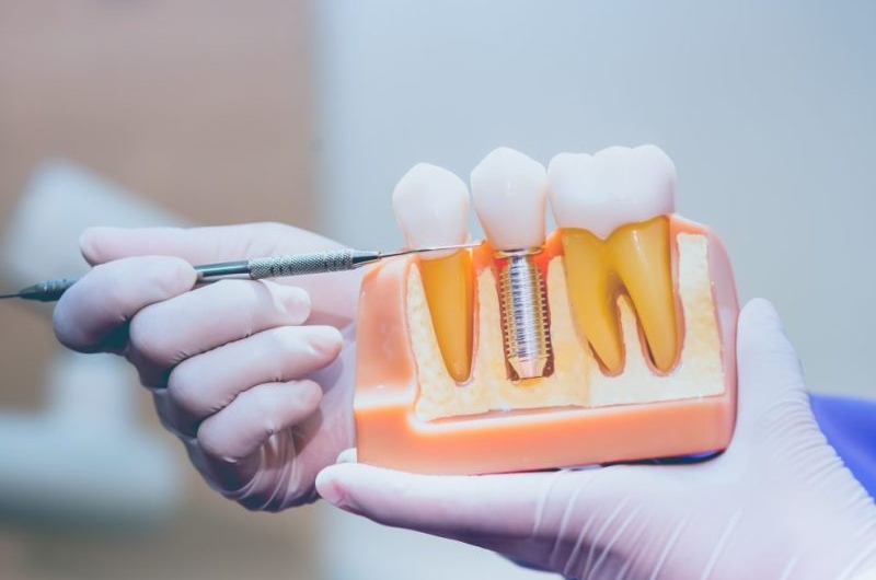 Guide-to-Dental-Implants-A-Complete-Overview