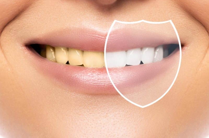 Know-What-to-Expect-During-and-After-Zoom-Teeth-Whitening-Treatment