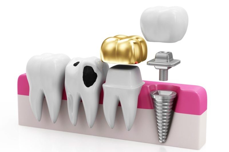 Know-the-Benefits-of-Same-Day-Dental-Crowns-with-CEREC-CAD_CAM