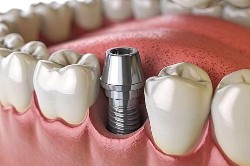 Metal-Crown-Dental-Implants-Strength-Durability-and-Aesthetic-Appeal