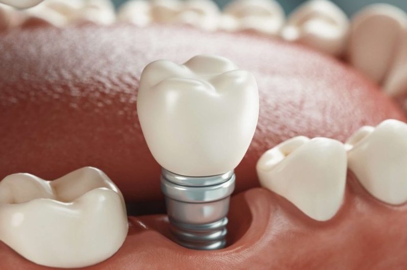 Mini-Dental-Implants-A-Compact-Solution-for-Big-Smiles