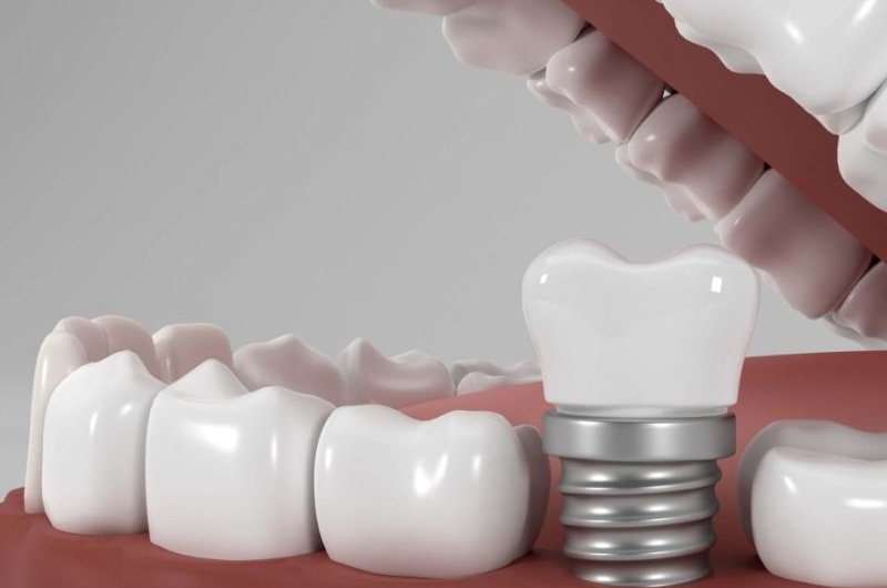 Same-Day-Dental-Implants-For-Immediate-Results-and-Rapid-Recovery