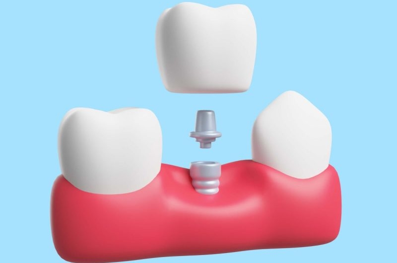 Single-Dental-Implants-Perfecting-Your-Smile-One-Tooth-at-a-Time