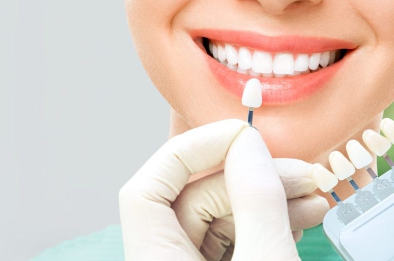 The-Wonders-Dental-Veneers-Bring-to-a-Smile