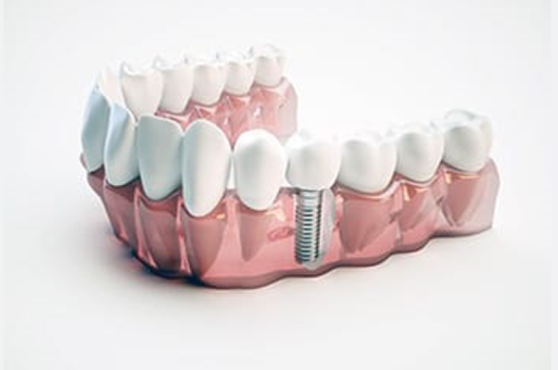 What-are-Dental-Implants-and-Why-is-it-Important