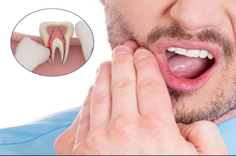 Wisdom Tooth Pain: Identifying Symptoms, Causes, and Effective Treatments