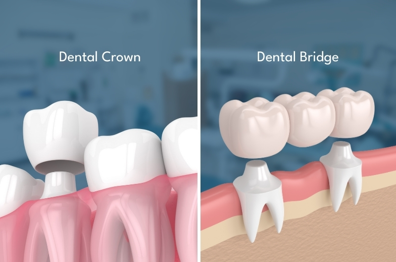 Dental-Crown-and-Bridge-Treatment